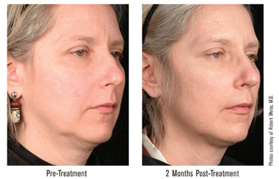 facial contours II facial contours II